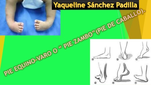 Pie Equino Varo Congenito Pdf Download